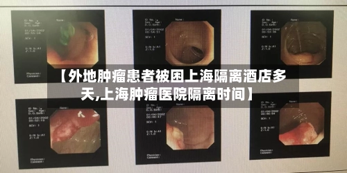 【外地肿瘤患者被困上海隔离酒店多天,上海肿瘤医院隔离时间】-第2张图片